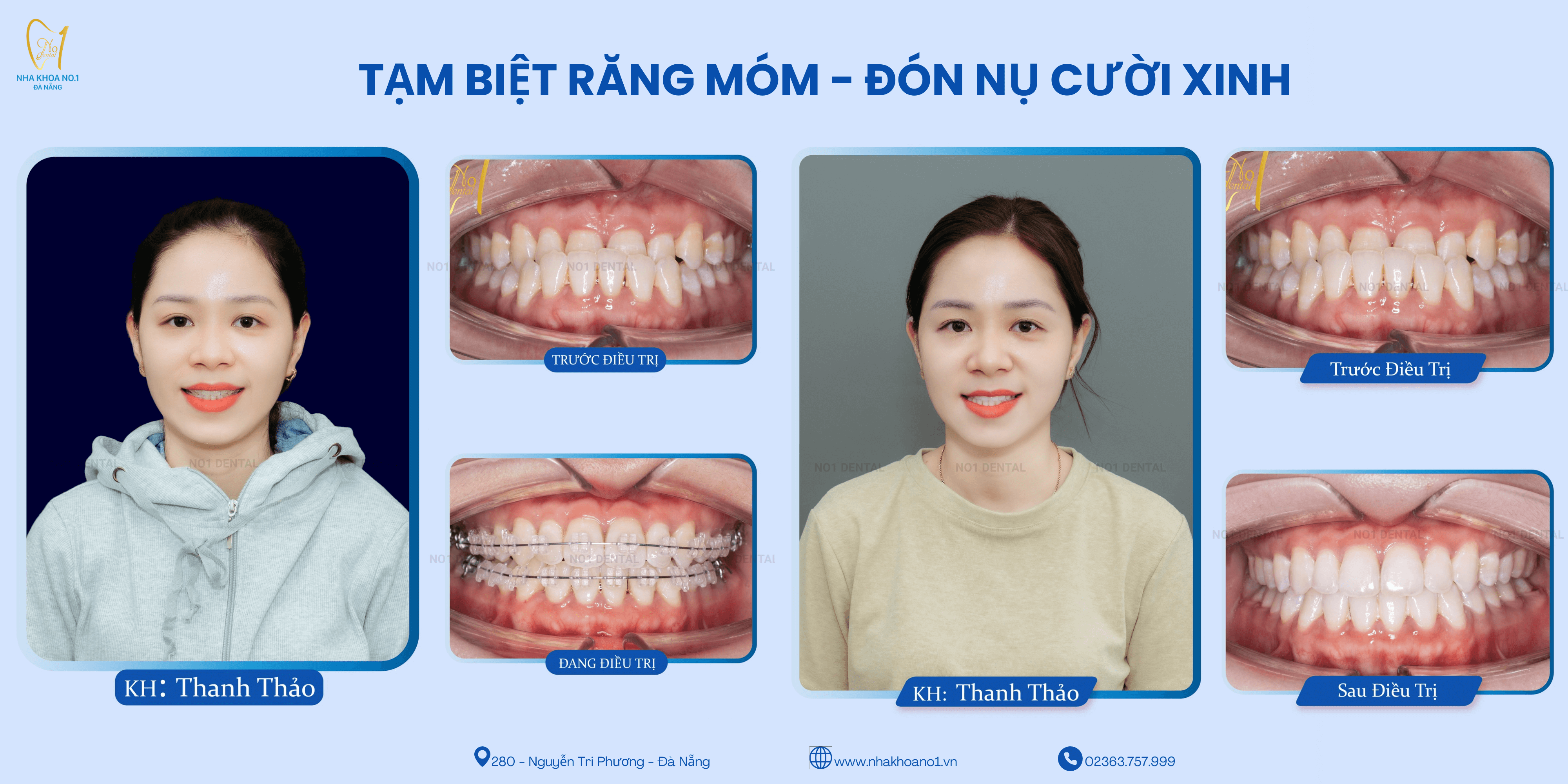 Kiên trì với niềng răng sẽ trả lại kết quả mỹ mãn