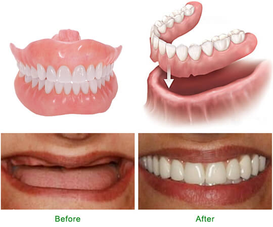 Trường hợp nào nên và không nên trồng răng giả?