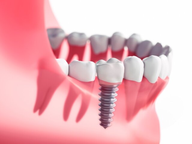 Sau khi trồng răng giả, mất bao lâu trồng lại răng mới?