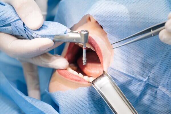 Giới thiệu kỹ thuật cấy ghép Implant