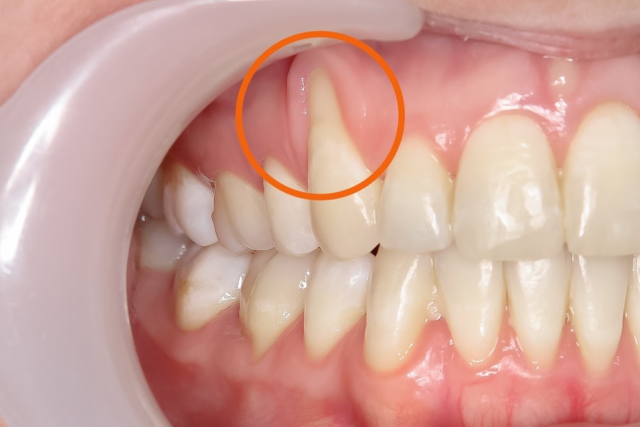 Bị tụt lợi là gì? Dấu hiệu ra sao?