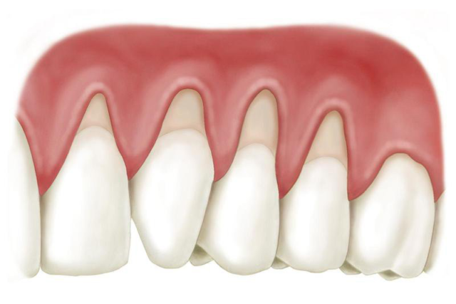 Điều trị răng bị tụt lợi