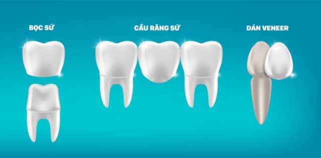 Tiêu chí lựa chọn bọc răng sứ hay dán răng sứ