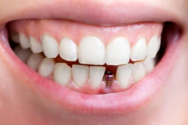 Giới thiệu về trồng răng Implant
