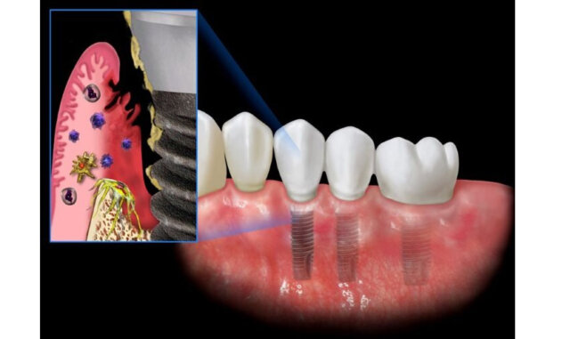 Biến chứng nguy hiểm của tình trạng sưng đau kéo dài sau cấy Implant
