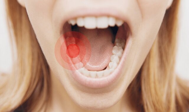 Cách giảm sưng đau tại nhà sau khi trồng răng Implant