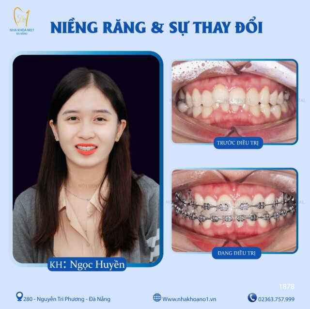 Niềng răng điều trị khớp cắn sâu tại Nha khoa No1 Đà Nẵng