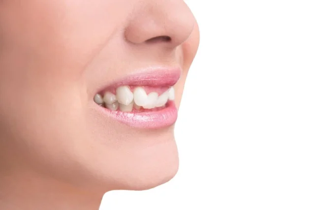 Nguyên nhân gây ra khớp cắn lệch sâu