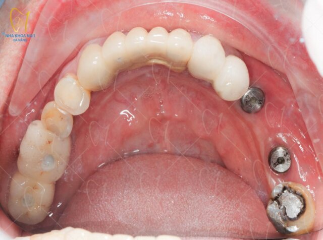 Cấy ghép Implant chất lượng tại Nha khoa No1 Đà Nẵng