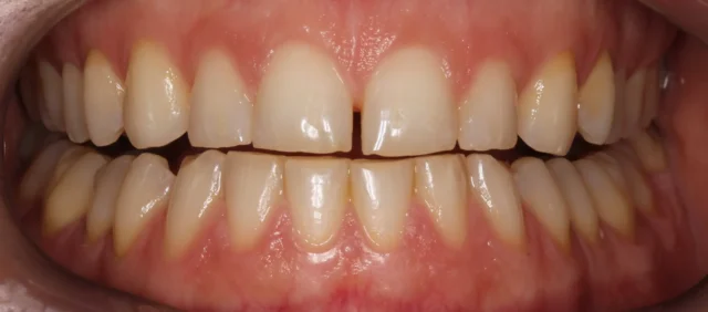 Tổng quan bệnh mòn răng là gì