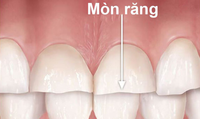 Những ảnh hưởng của mòn răng là gì?