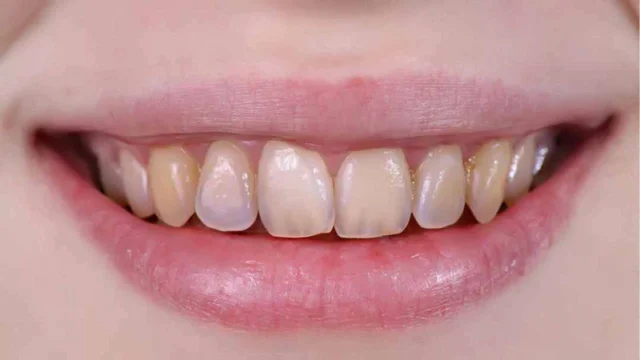 Cần phải làm gì khi bị mòn men răng?