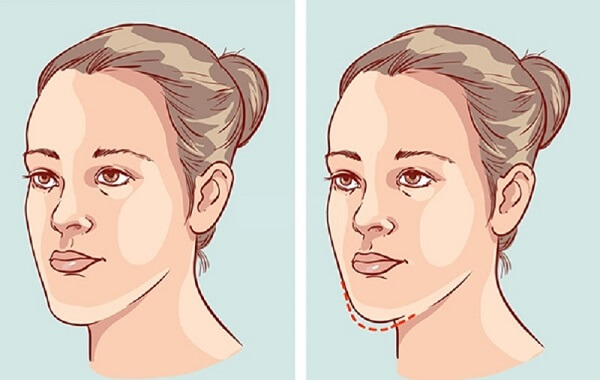 Niềng răng làm thay đổi khuôn mặt như thế nào?