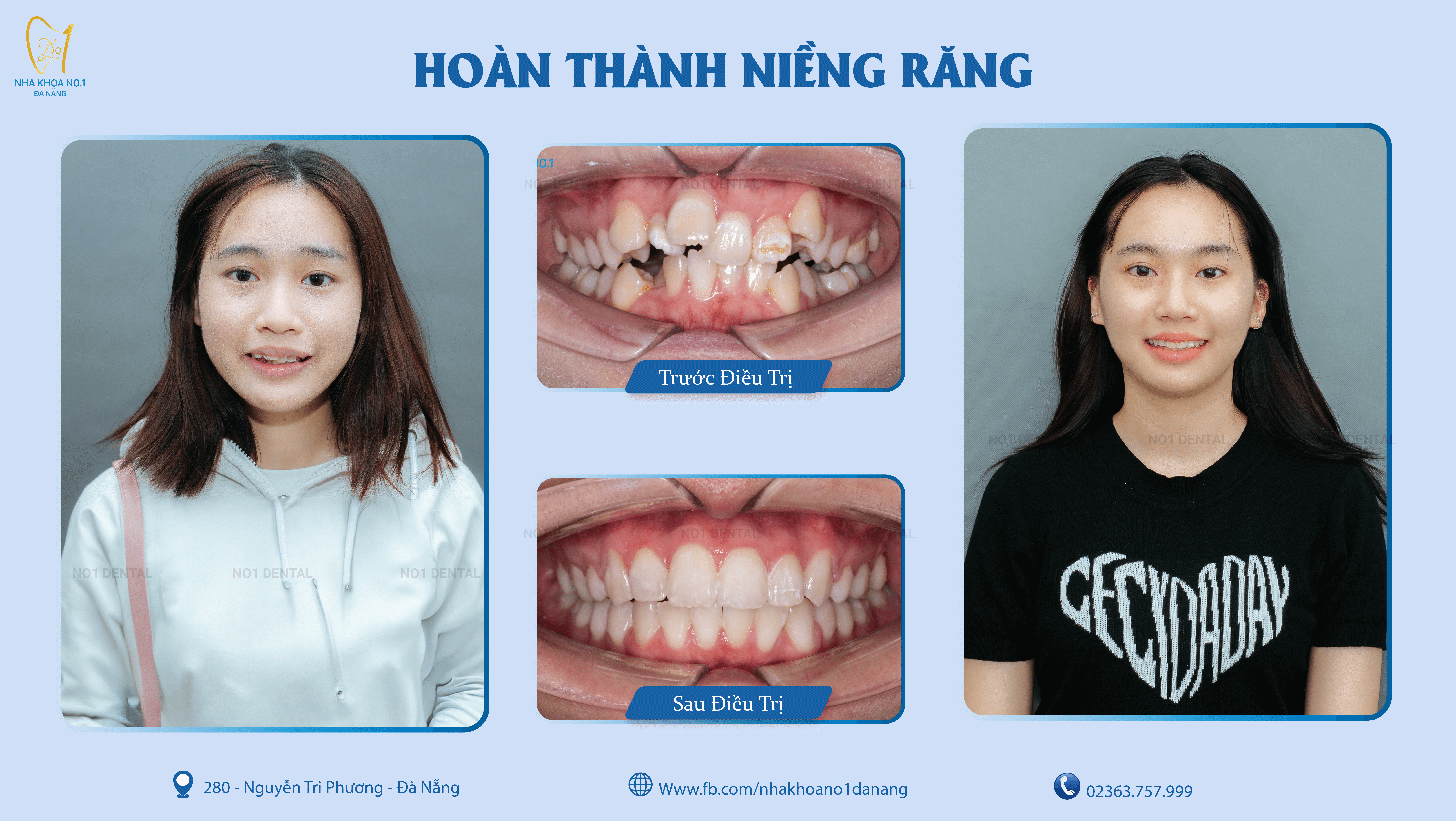 nieng-rang-co-cong-dung-lam-thay-doi-guong-mat-khong
