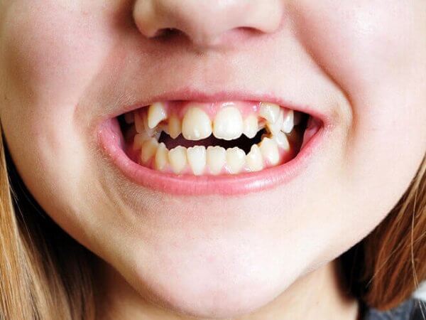 Sơ lược về răng khểnh là gì?