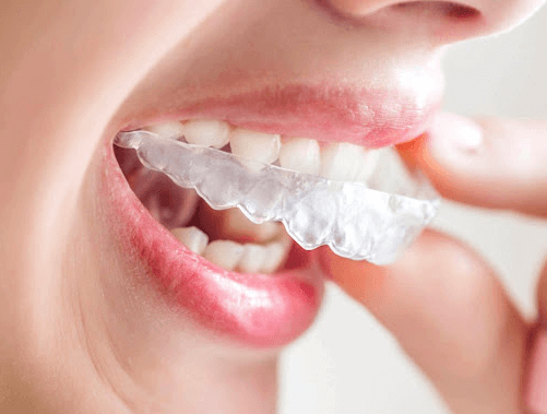 Cơ chế hoạt động khi niềng răng invisalign