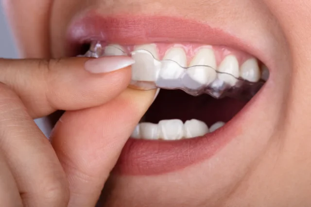 Quy trình niềng răng invisalign