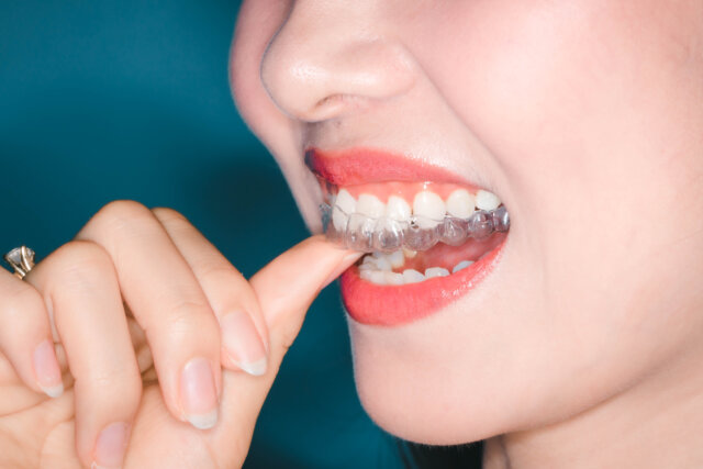 Niềng răng Invisalign chất lượng tại Nha khoa No1 Đà Nẵng