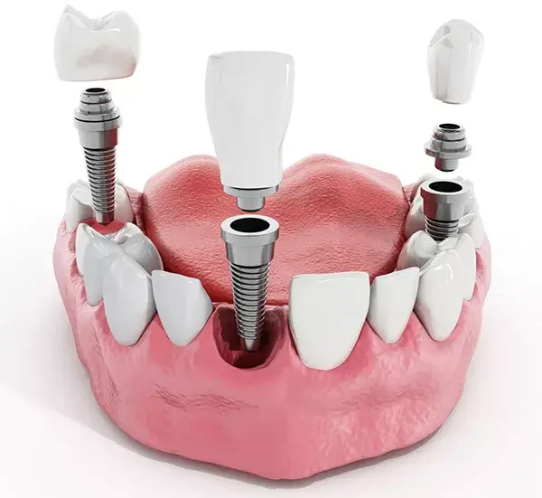 Trồng răng Implant có an toàn không?