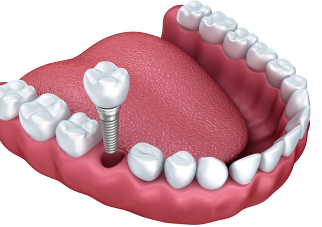 Điều kiện sức khỏe giúp làm răng Implant an toàn 100%