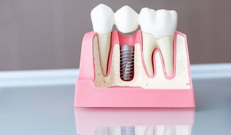 phuong-phap-trong-rang-implant-4