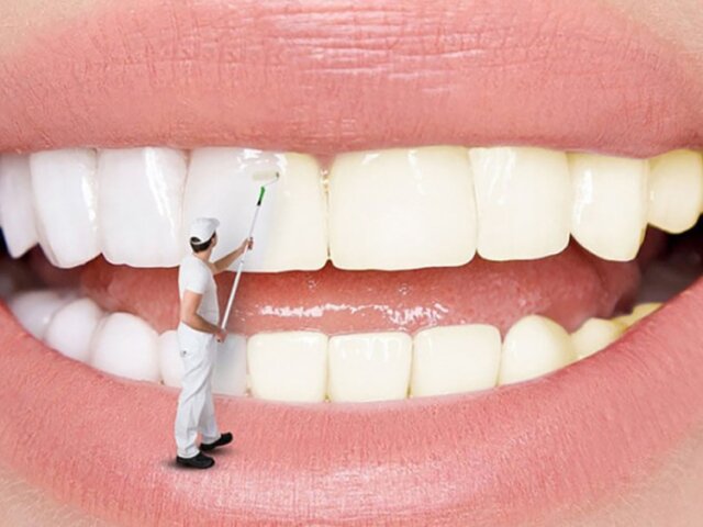 NÊN TẨY TRẮNG RĂNG BAO LÂU 1 LẦN VÀ  TẨY NHIỀU LẦN CÓ SAO KHÔNG?