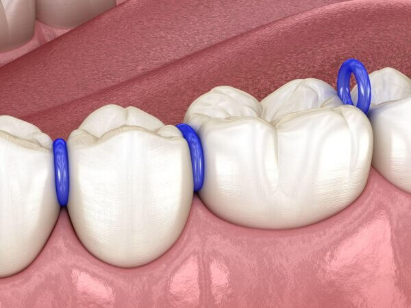 Giải đáp thun tách kẽ răng