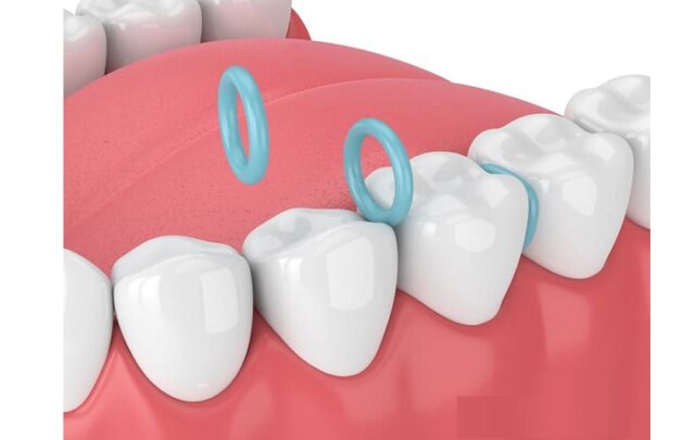 Điểm danh 2 phương pháp đặt thun tách kẽ