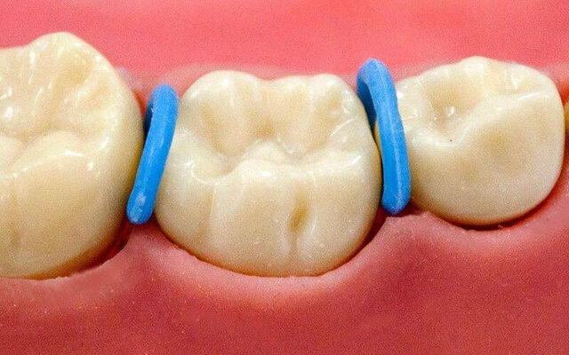 Một số lưu ý cần nắm sau khi đặt thun tách kẽ