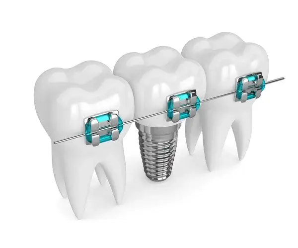 Trồng Implant rồi có thể niềng răng không?