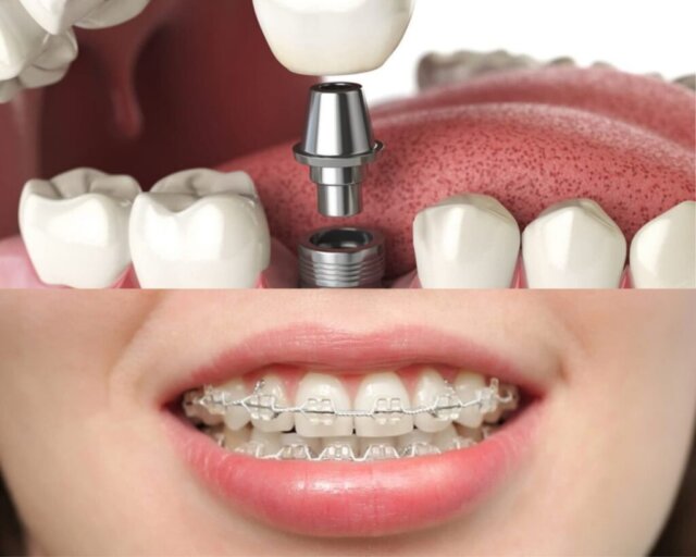 Quy trình niềng răng sau khi trồng Implant