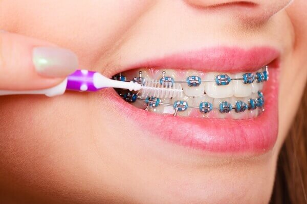 Chăm sóc răng implant sau khi đã niềng
