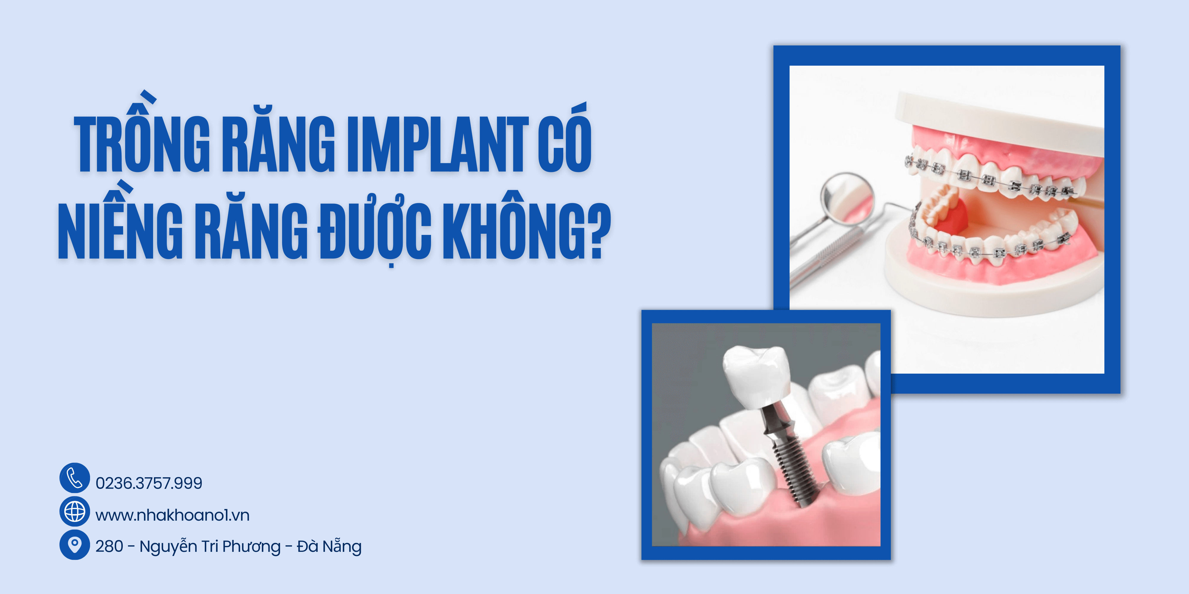 trong-implant-roi-co-the-nieng-rang-khong