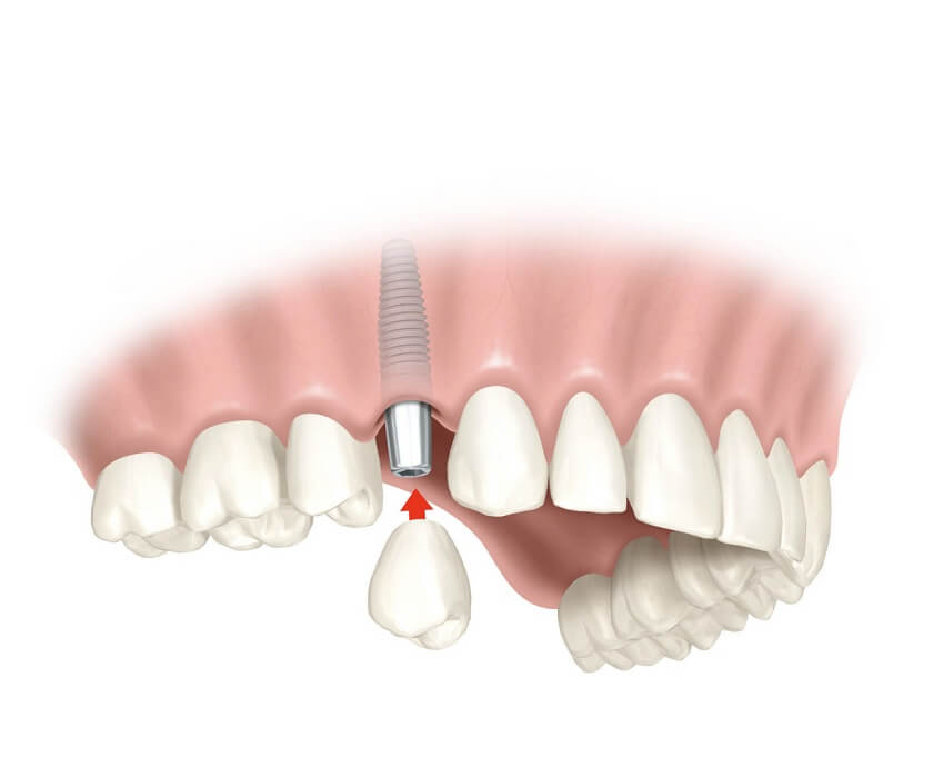 tru-rang-implant-tuc-thi-4