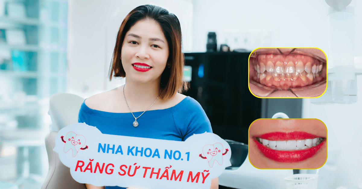 Răng sứ thẩm mỹ tại Nha Khoa No1 Đà Nẵng