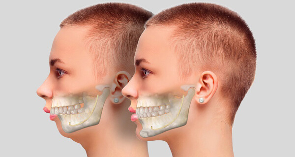 Tồn tại phương pháp điều chỉnh răng hô không cần niềng hay không?