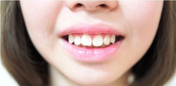 Chỉnh răng hô tại nhà không cần niềng
