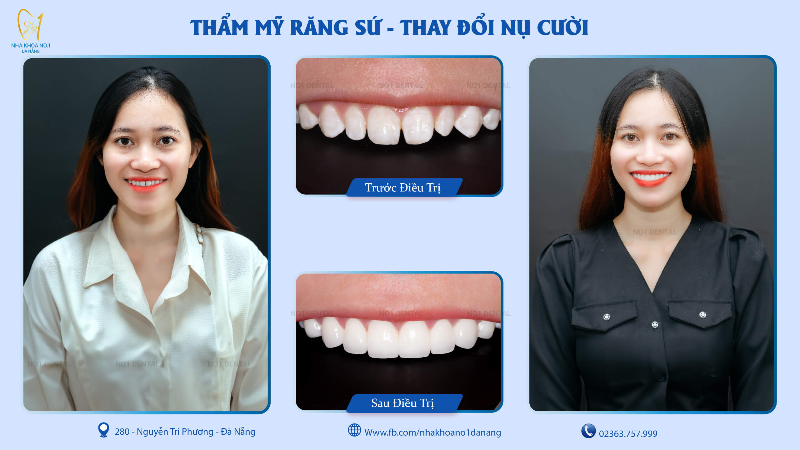 Răng sứ thẩm mỹ tại Nha Khoa No1 Đà Nẵng
