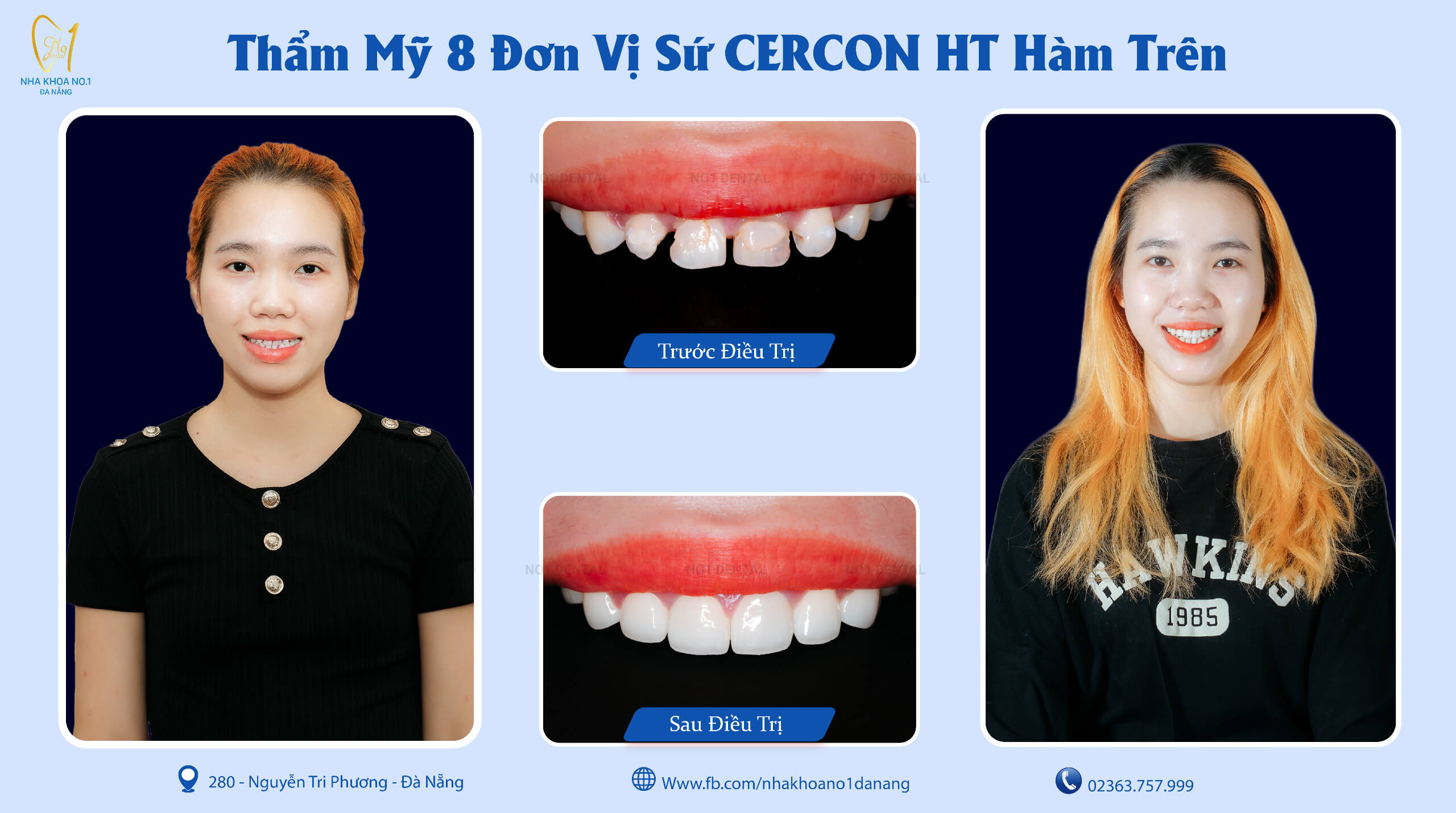 Răng sứ thẩm mỹ tại Nha Khoa No1 Đà Nẵng