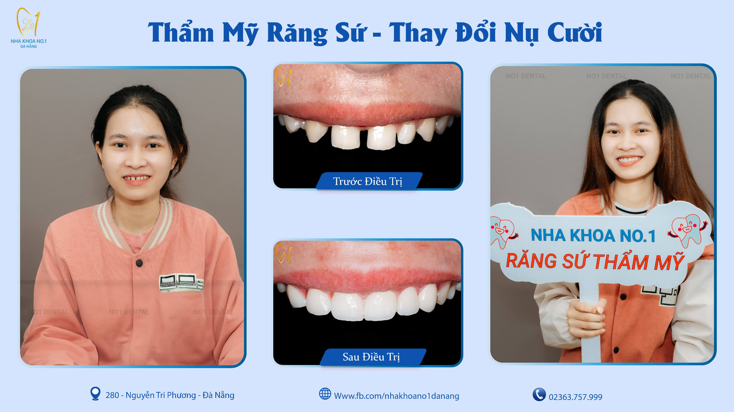 Răng sứ thẩm mỹ tại Nha Khoa No1 Đà Nẵng