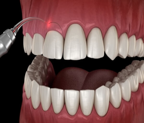 mai-go-xuong-rang-4