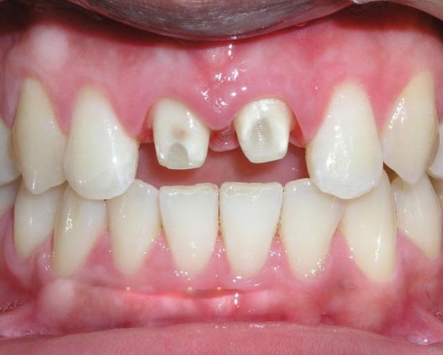 Mài răng bọc sứ có gây cảm giác đau ê khó chịu không?