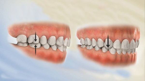 Công dụng của nâng khớp cắn trong quá trình chỉnh nha