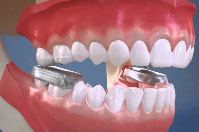 Cần thiết phải nâng khớp cắn không?
