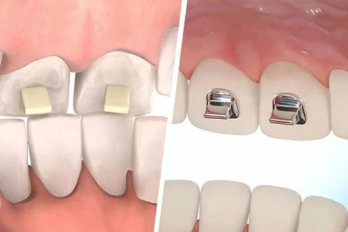 Cảm giác khi nâng khớp cắn như thế nào?