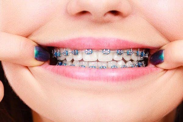 Hướng dẫn chăm sóc răng miệng khi đang niềng