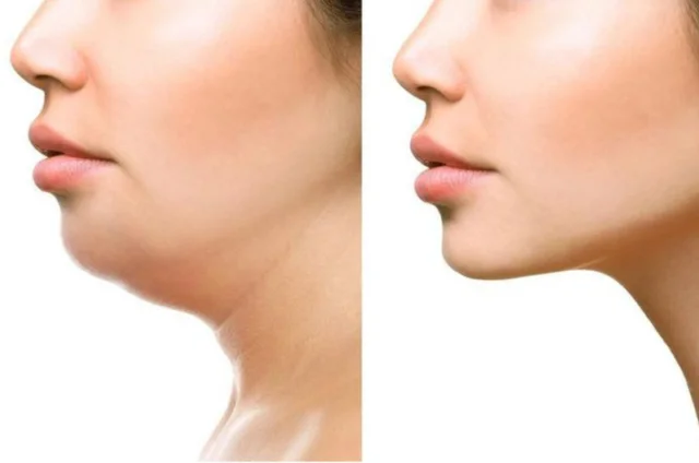 Thế nào là tình trạng cằm lẹm?