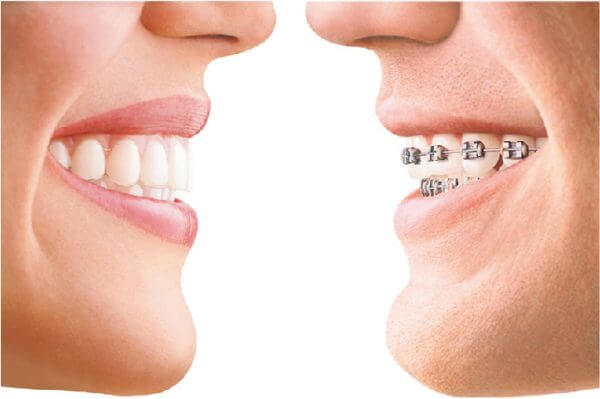Niềng răng có khả năng chữa cằm lẹm không?