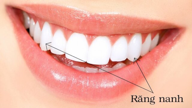 Giới thiệu về răng nanh là gì