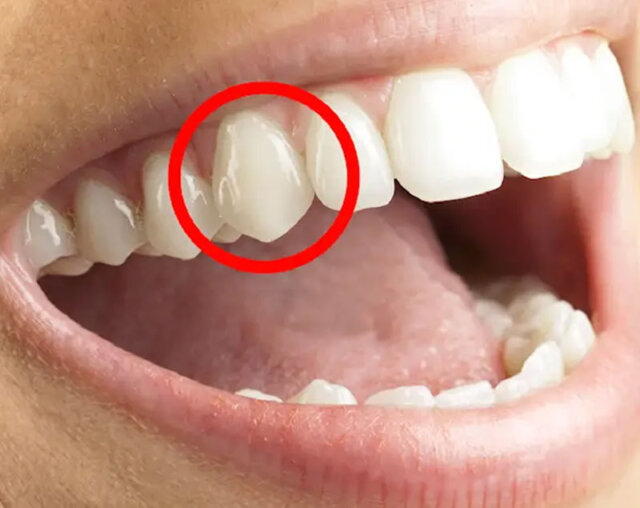 Tổng hợp các câu hỏi phổ biến về răng nanh?
